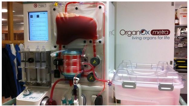 كان جراحون من استراليا قد أجروا العام الماضي أول عملية زرع في العالم لقلب غير نابض 