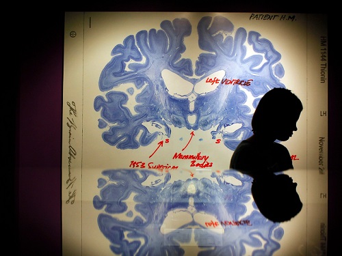 سيدة تبتعد ويظهر خلفها شريحة عرض لمخ الإنسان