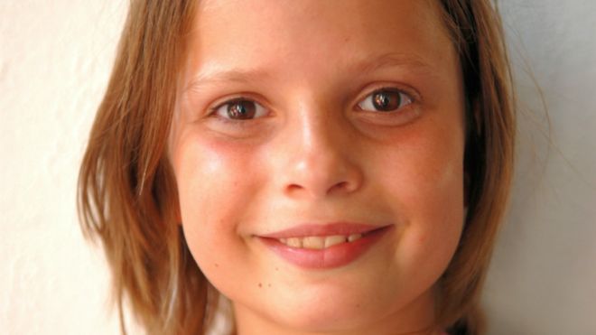 الانتفاخات والهالات السوداء حول العين 