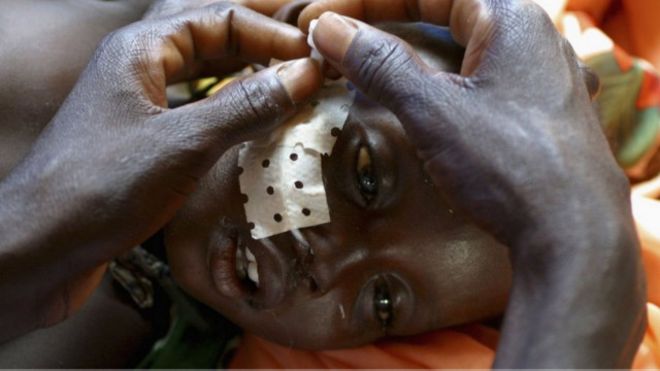 طفل مصاب بداء الليشمانيات 