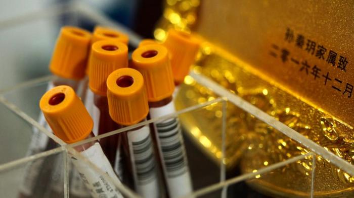 قوارير الدم في مركز جراحة الأعصاب الوظيفية بمستشفى رويجين في شنغهاي ، الصين في 29 أكتوبر 2018