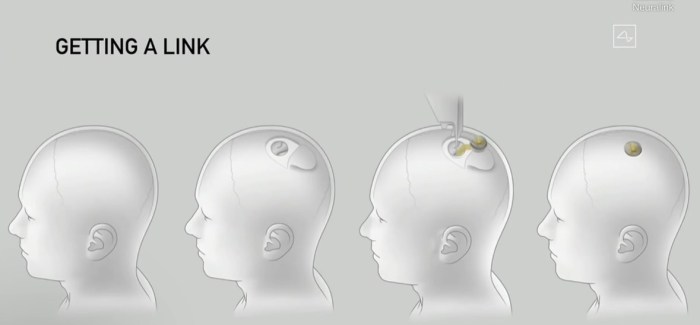 طريقة عمل ثقب في الجمجمة لزراعة الشريحة الإلكترونية
