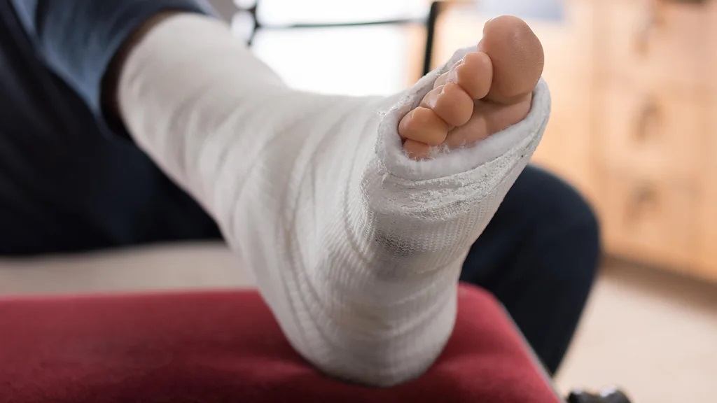 يمكن لصق معظم أصابع القدم المكسورة على أصابع القدم على كلا الجانبين وتثبيتها في حذاء صلب خاص